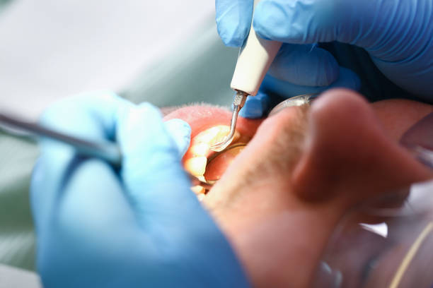 Best Knocked-Out Tooth (Avulsed Tooth) Treatment in Stony Point, MI